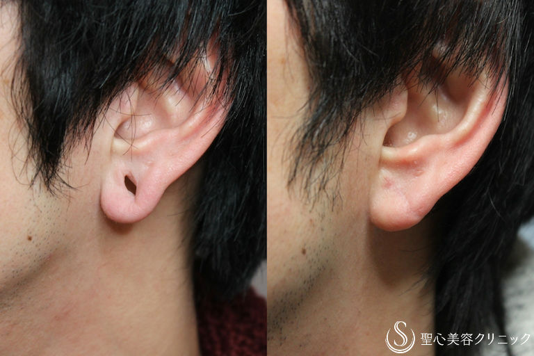【30代男性・ピアスホール】ピアス穴閉じ（術後1.5ヶ月） After 