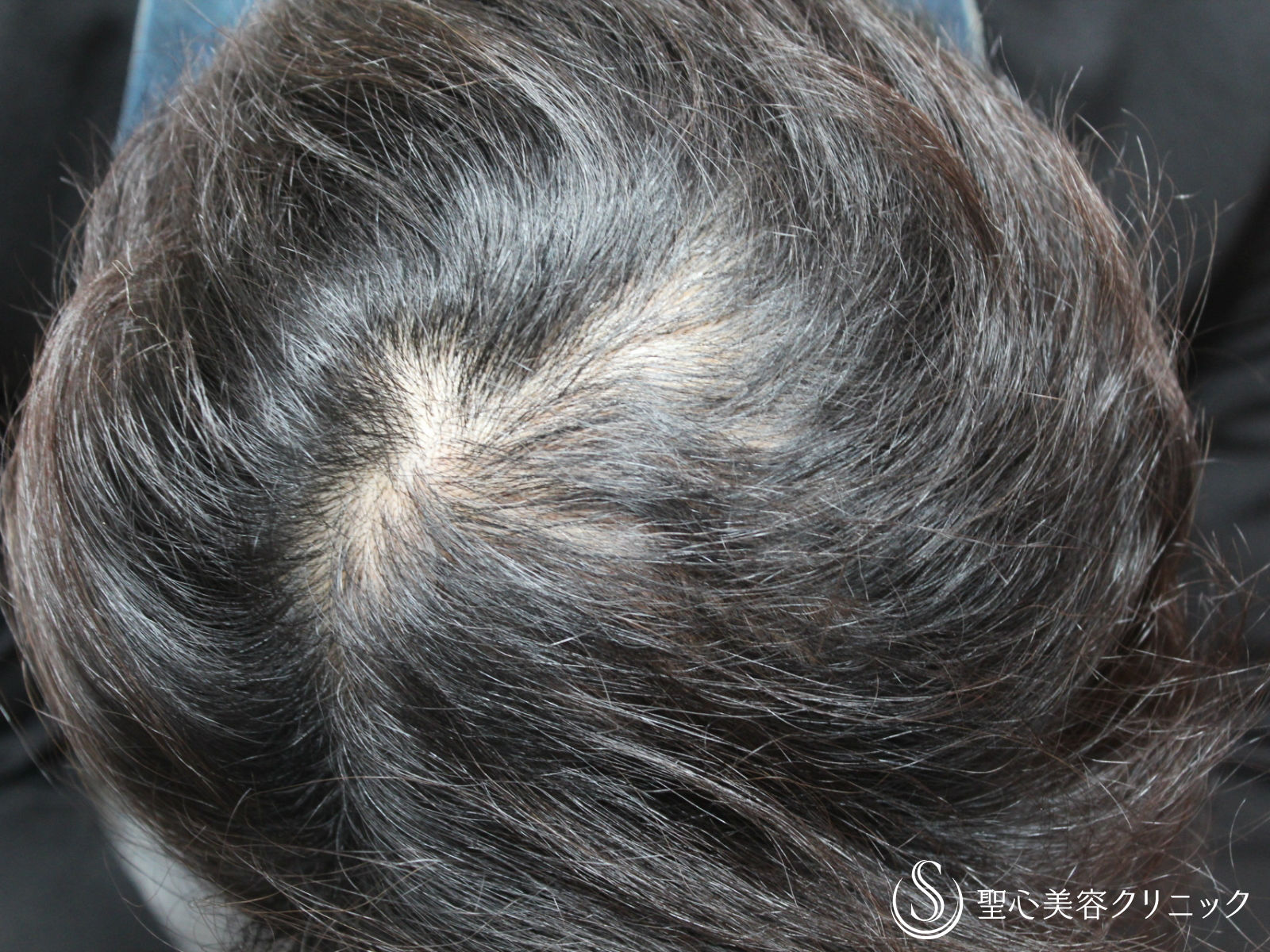 【50代男性・薄毛】グロースファクター再生療法＋アボルブ（術後3ヶ月） After 