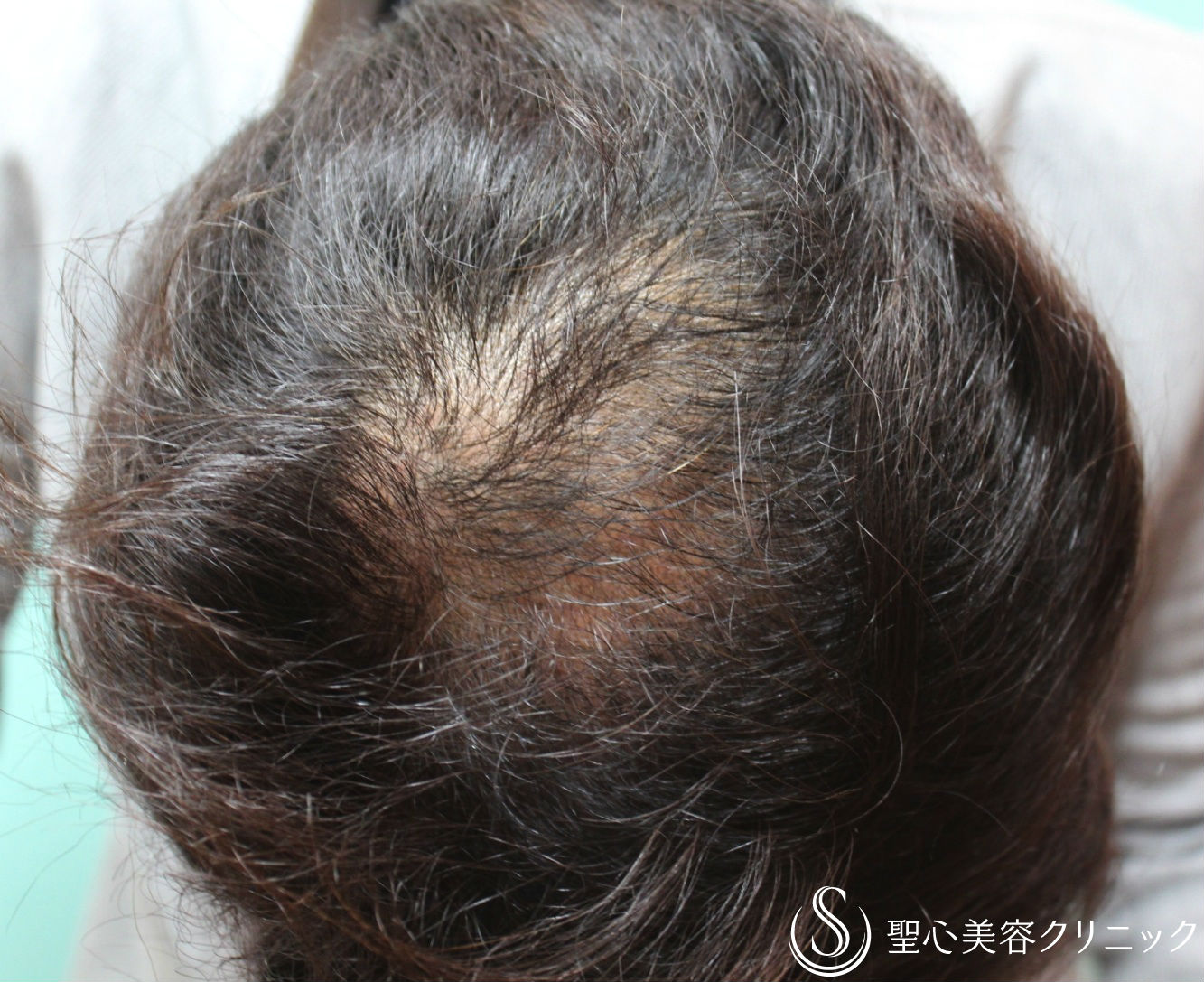 【50代男性・薄毛】グロースファクター再生療法＋アボルブ（術後3ヶ月） Before 