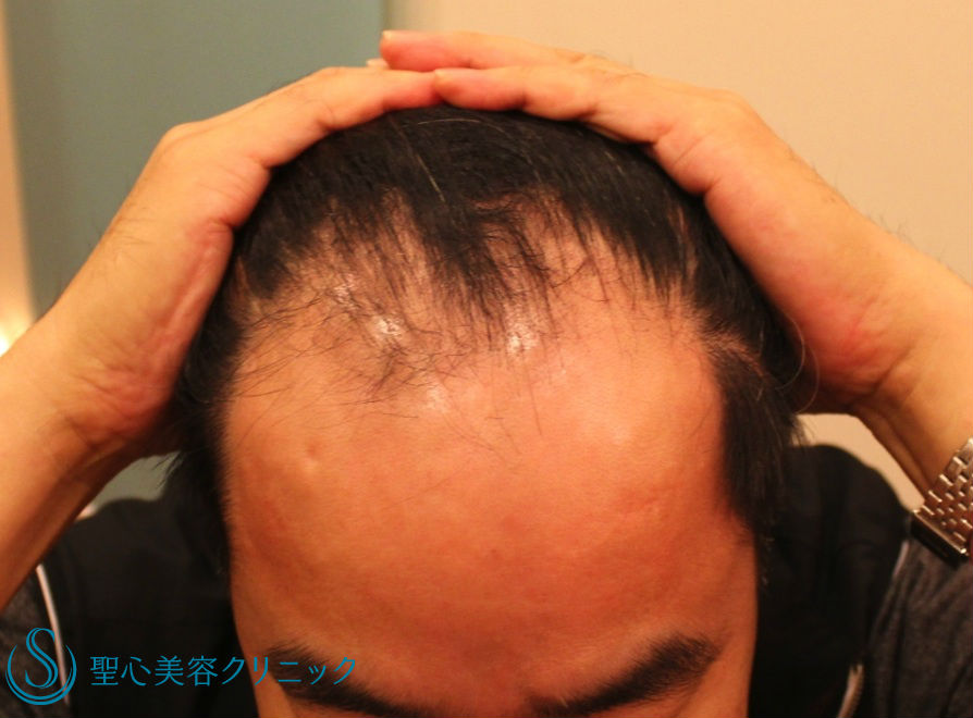 【５０代男性・薄毛】グロースファクター再生療法＋アボルブ＋リアップ（治療開始３年） Before 