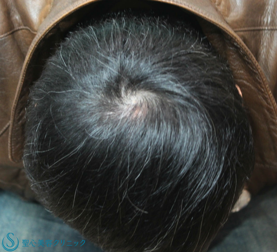 【５０代男性・薄毛】グロースファクター再生療法＋アボルブ＋リアップ（治療開始３年） After 