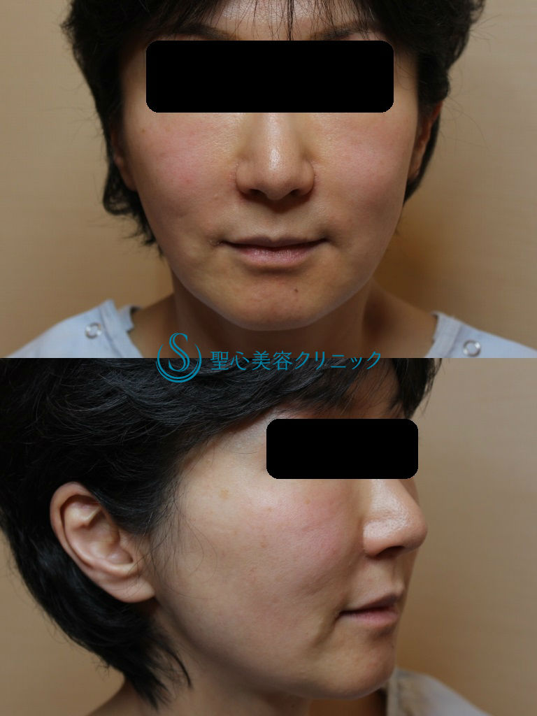 【４０代女性・たるみを解消】こめかみリフト、フェイスリフト Before 