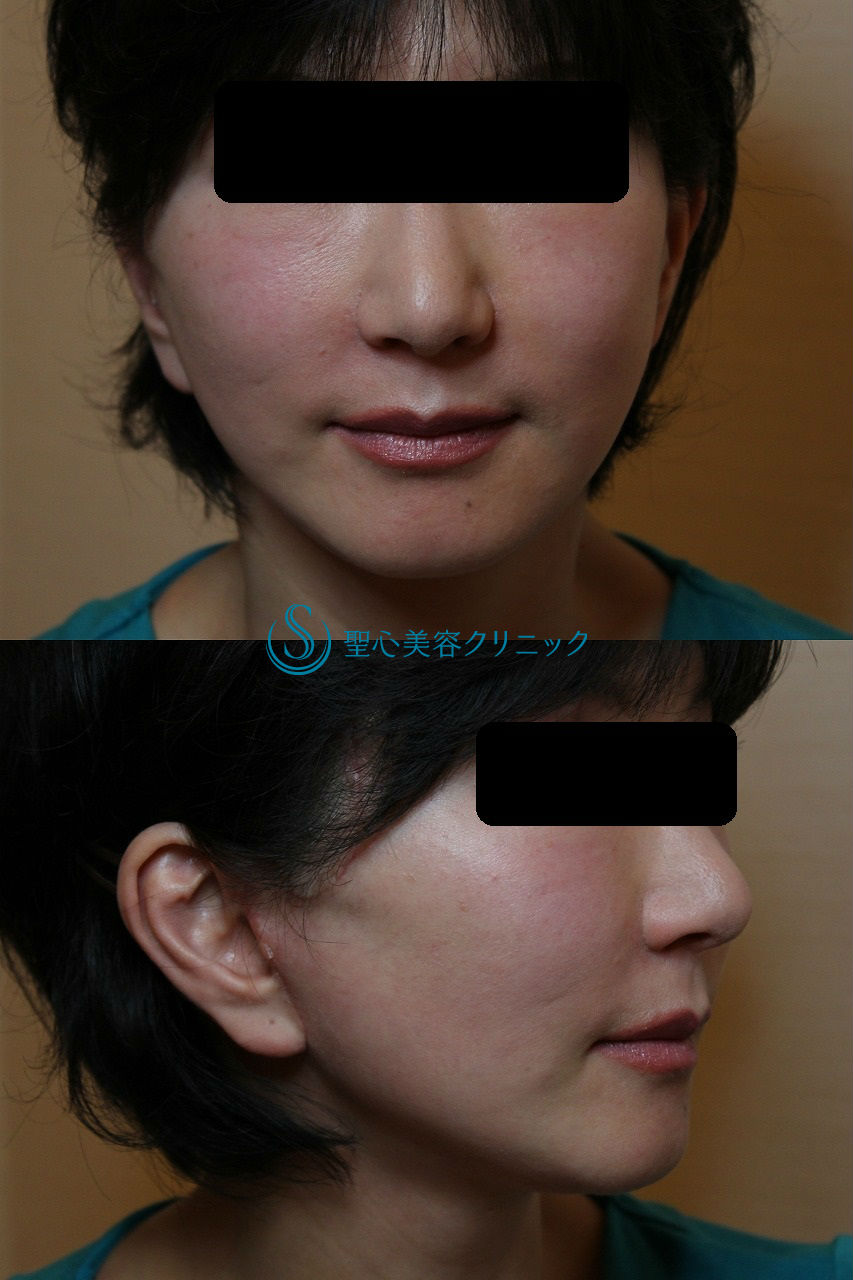 【４０代女性・たるみを解消】こめかみリフト、フェイスリフト After 