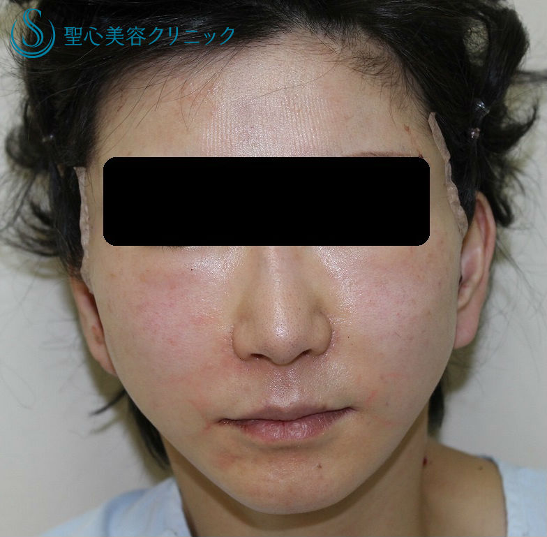 【４０代女性・たるみを解消】こめかみリフト、フェイスリフト After 