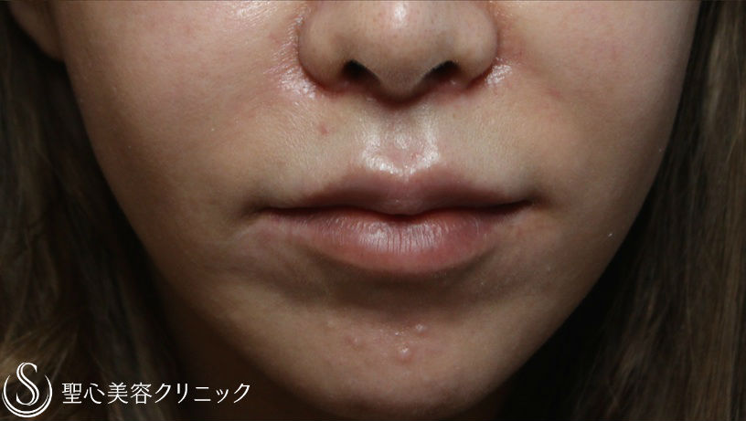 【40代女性・唇をふっくらと】リップリフト(鼻下短縮術)（術後1ヶ月） After 