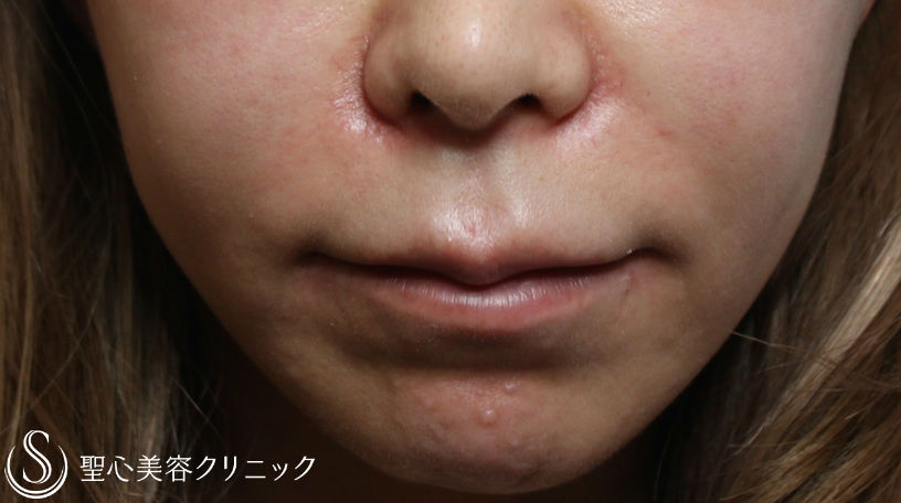 【40代女性・唇をふっくらと】リップリフト(鼻下短縮術)（術後1ヶ月） Before 