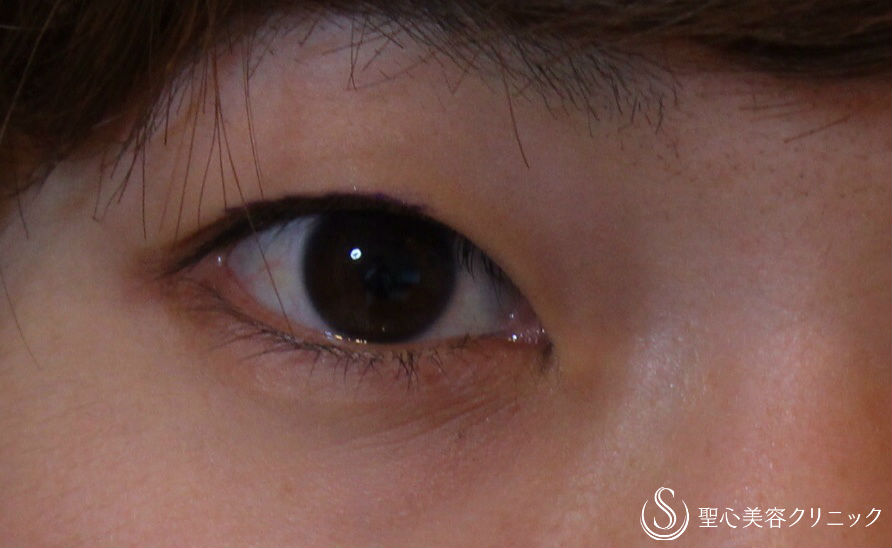 【30代女性・平行型の二重】マイクロメソッド法＋α（術直後） Before 