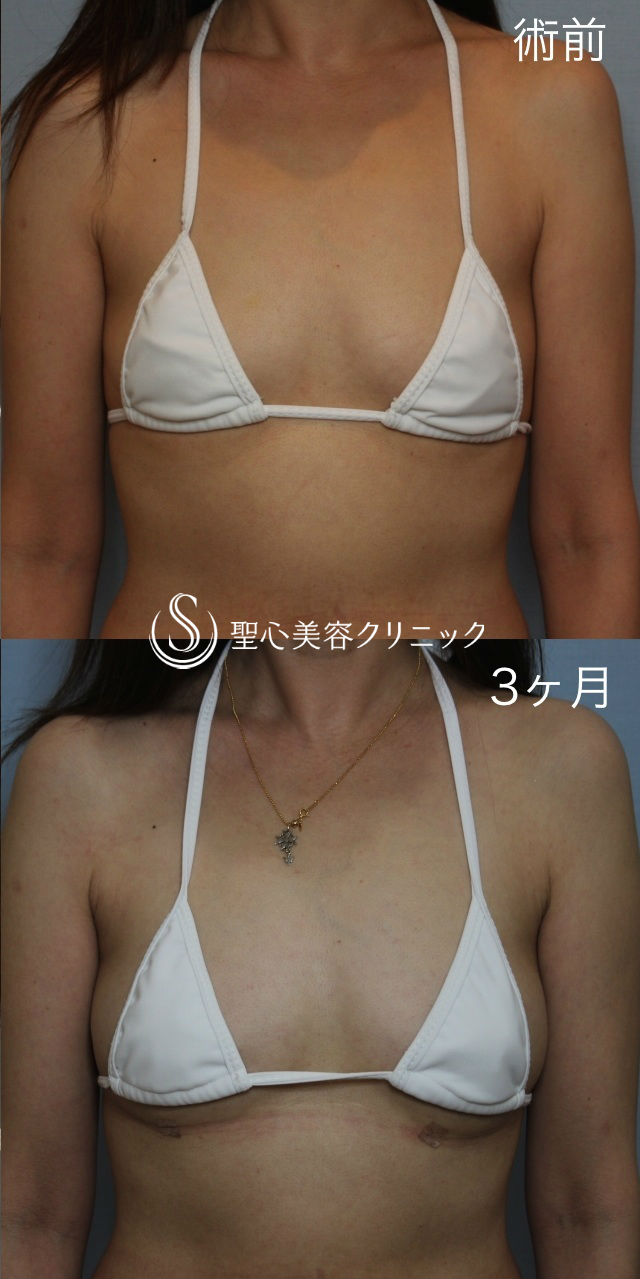 【40代女性・自然なバストアップ】セリューション豊胸術（術後3ヶ月） After 