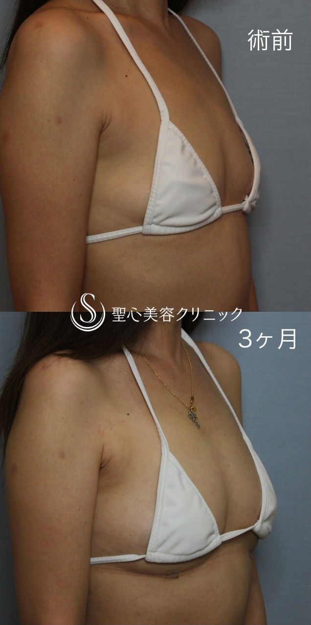 【40代女性・自然なバストアップ】セリューション豊胸術（術後3ヶ月） After 