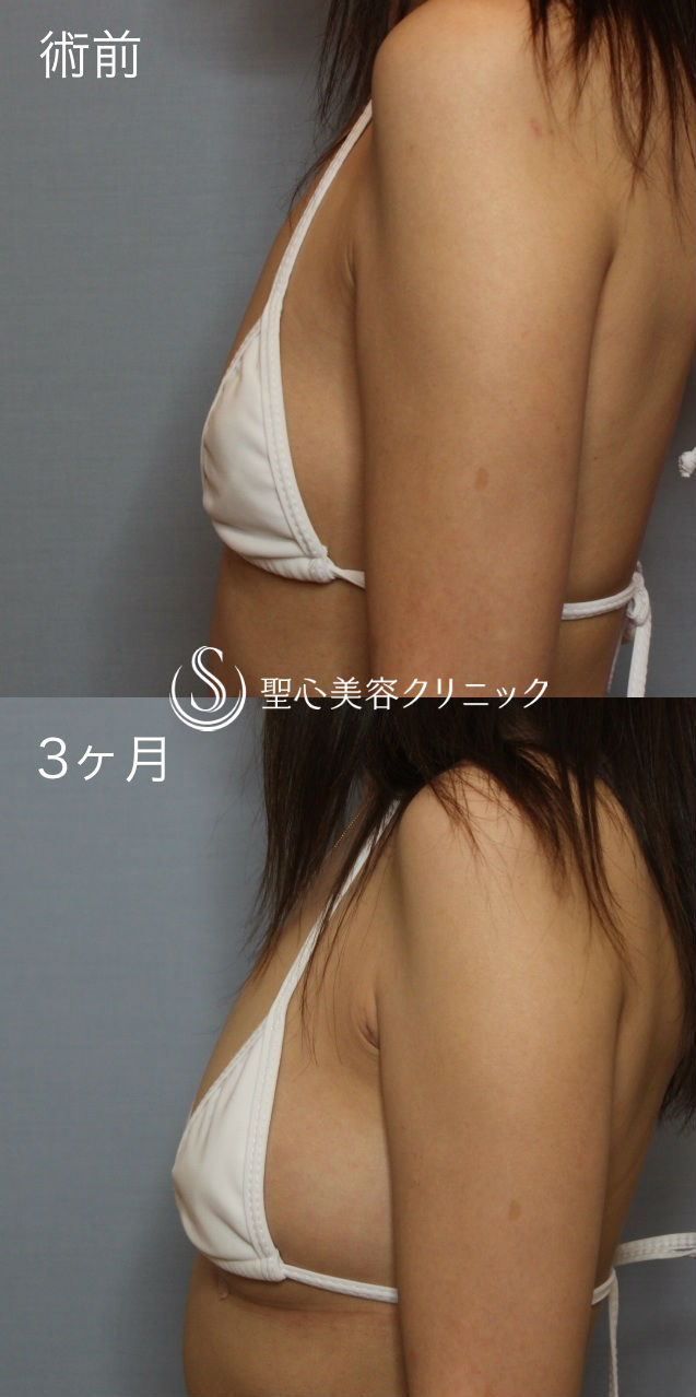 【40代女性・自然なバストアップ】セリューション豊胸術（術後3ヶ月） After 