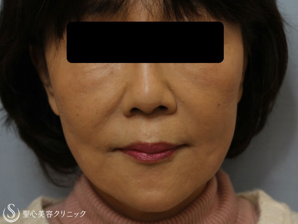 【60代女性・口元/フェイスラインのたるみ】スプリングスレッドリフト（術後1ヶ月） After 