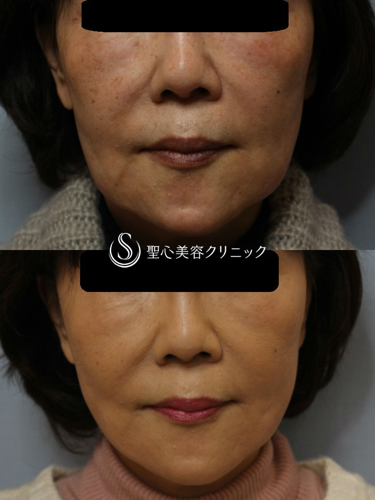 【60代女性・口元/フェイスラインのたるみ】スプリングスレッドリフト（術後1ヶ月） After 