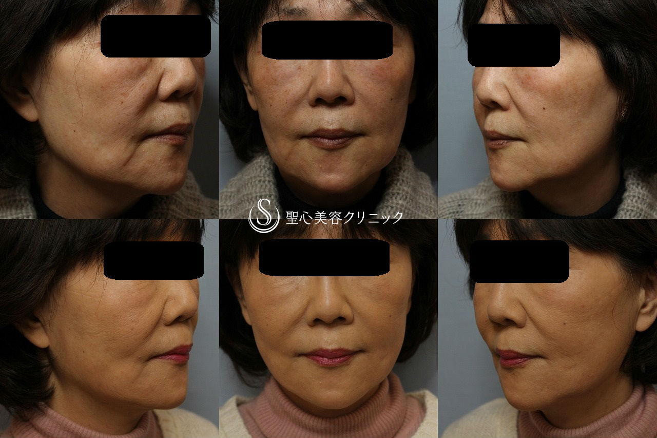 【60代女性・口元/フェイスラインのたるみ】スプリングスレッドリフト（術後1ヶ月） After 