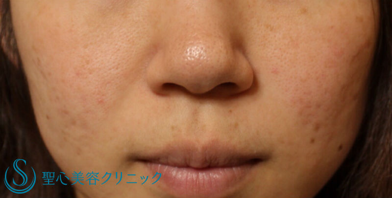 【20代女性・丸い鼻をすっきりと】鼻尖縮小＋小鼻縮小（術後1ヶ月） Before 