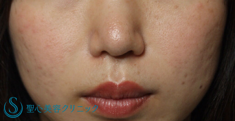 【20代女性・丸い鼻をすっきりと】鼻尖縮小＋小鼻縮小（術後1ヶ月） After 