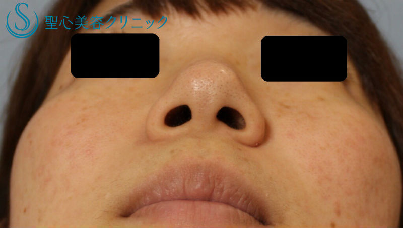 【20代女性・丸い鼻をすっきりと】鼻尖縮小＋小鼻縮小（術後1ヶ月） Before 