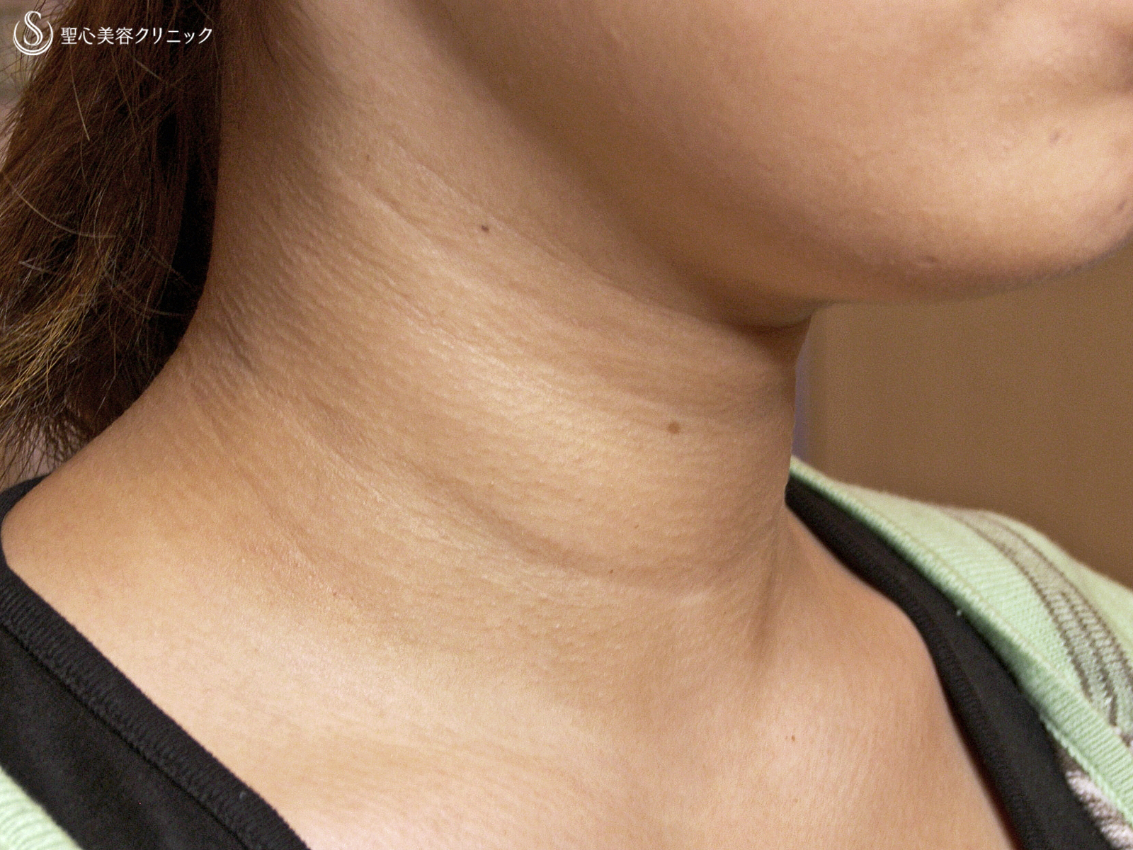 【20代女性・首の横ジワ長期経過】プレミアムPRP皮膚再生療法（処置後13年） Before 