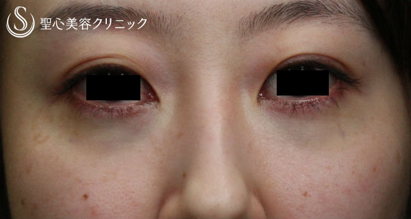 【20代女性・目のくまを取る】経結膜下脱脂術（術後4日） After 