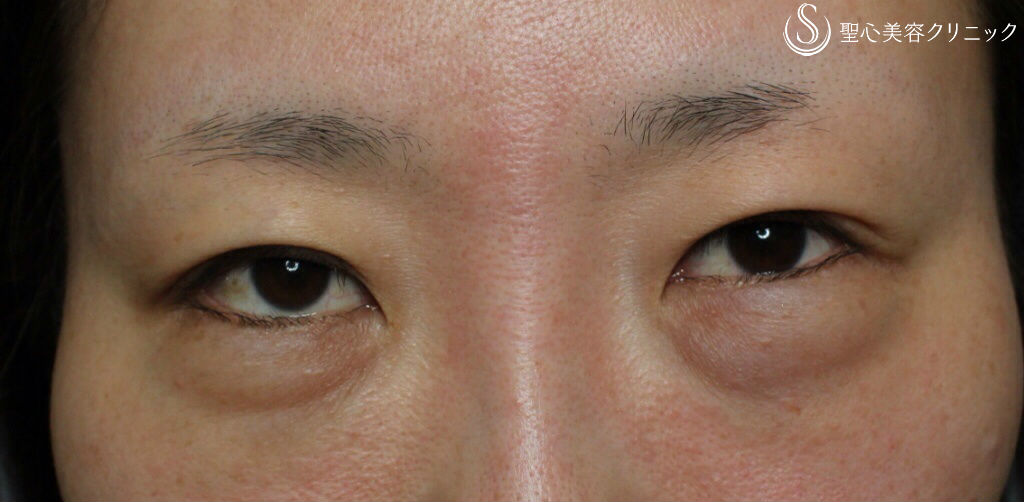 30代女性 つり目改善 グラマラスライン たれ目 形成術 埋没法 術後1ヶ月 症例写真 美容整形 美容外科なら聖心美容クリニック 30代女性 つり目改善 グラマラスライン たれ目 形成術 埋没法 術後1ヶ月 症例写真 美容整形 美容外科なら聖心美容クリニック