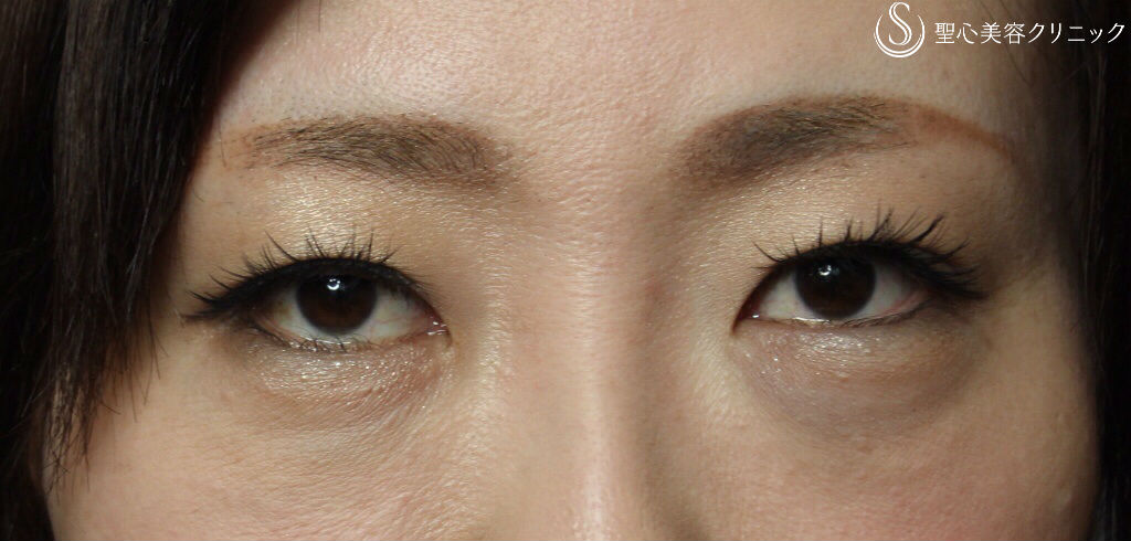 30代女性 つり目改善 グラマラスライン たれ目 形成術 埋没法 術後1ヶ月 症例写真 美容整形 美容外科なら聖心美容クリニック 30代女性 つり目改善 グラマラスライン たれ目 形成術 埋没法 術後1ヶ月 症例写真 美容整形 美容外科なら聖心美容クリニック
