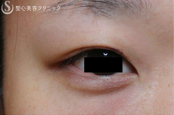 【20代女性・ぱっちり平行型二重】全切開法（術後1ヶ月） Before 