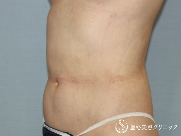 【40代女性・お腹の脂肪を取る】ベイザー脂肪吸引（3ヶ月後） After 