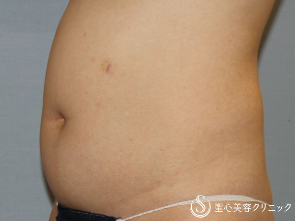 【40代女性・お腹の脂肪を取る】ベイザー脂肪吸引（3ヶ月後） Before 