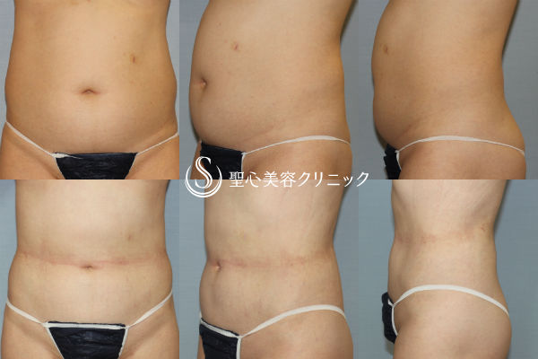 【40代女性・お腹の脂肪を取る】ベイザー脂肪吸引（3ヶ月後） After 