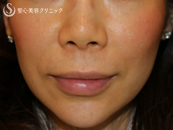 【30代女性・小顔】エラのボトックス注射（3ヶ月後） After 