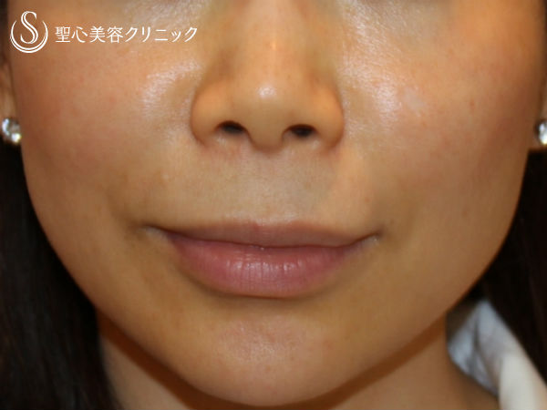 【30代女性・小顔】エラのボトックス注射（3ヶ月後） Before 
