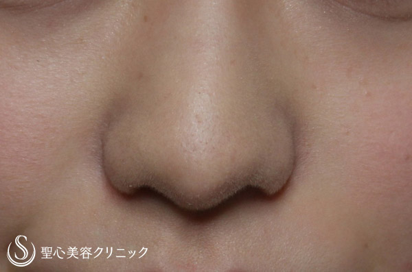 【20代・女性　鼻柱形成】耳介軟骨移植 After 