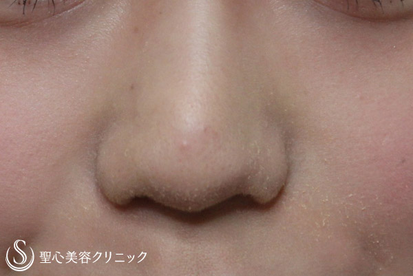 【20代・女性　鼻柱形成】耳介軟骨移植 Before 