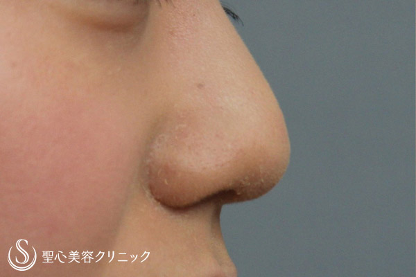 【20代・女性　鼻柱形成】耳介軟骨移植 After 