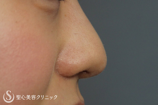【20代・女性　鼻柱形成】耳介軟骨移植 After 