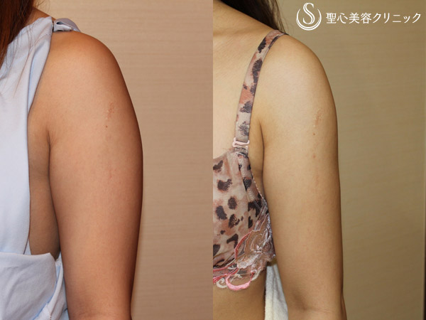 【20代女性・二の腕】ベイザー脂肪吸引（3ヶ月後） After 