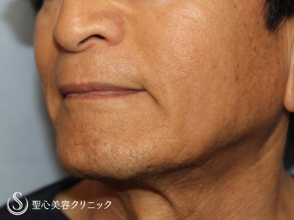 【70代男性・若返り治療】プレミアムPRP（8年前よりも若い70代男性） After 