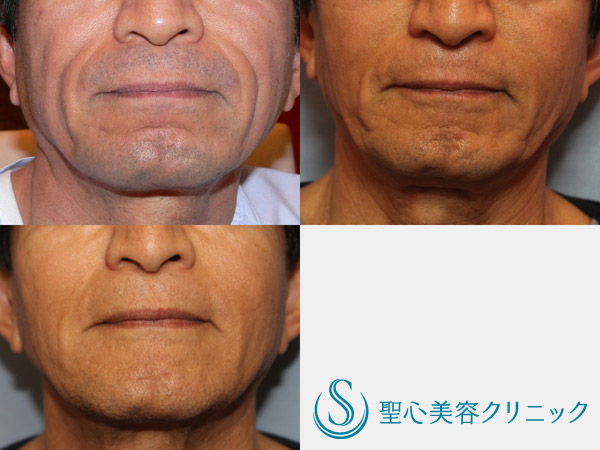【70代男性・若返り治療】プレミアムPRP（8年前よりも若い70代男性） After 