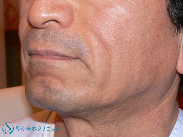 【70代男性・若返り治療】プレミアムPRP（8年前よりも若い70代男性） Before 