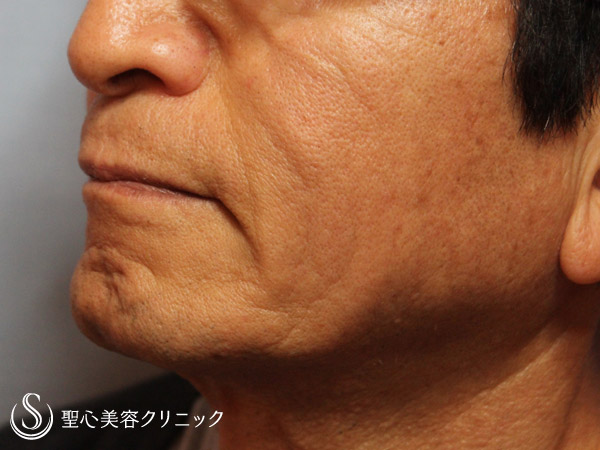 【70代男性・若返り治療】プレミアムPRP（8年前よりも若い70代男性） Before 