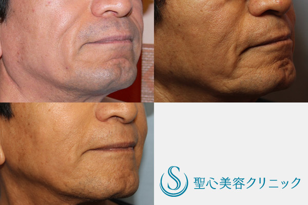 【70代男性・若返り治療】プレミアムPRP（8年前よりも若い70代男性） After 