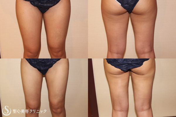 【20代女性・太もも】ベイザー脂肪吸引（太もも）（3ヶ月後） After 