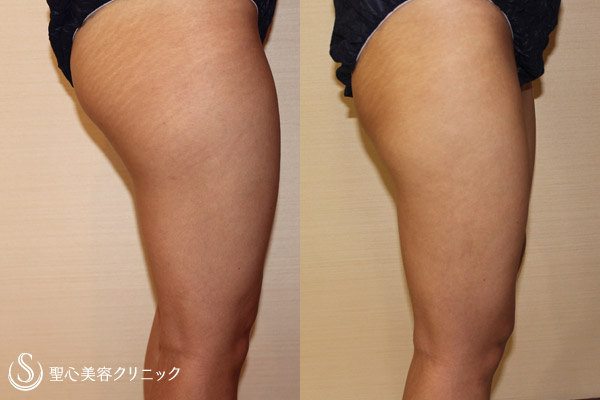 【20代女性・太もも】ベイザー脂肪吸引（太もも）（3ヶ月後） After 