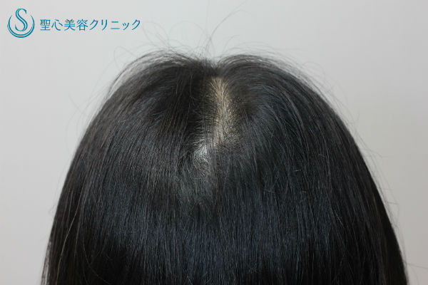 【40代女性・薄毛】グロースファクター再生療法、KIPスカルプへエッセンス、パントガール After 