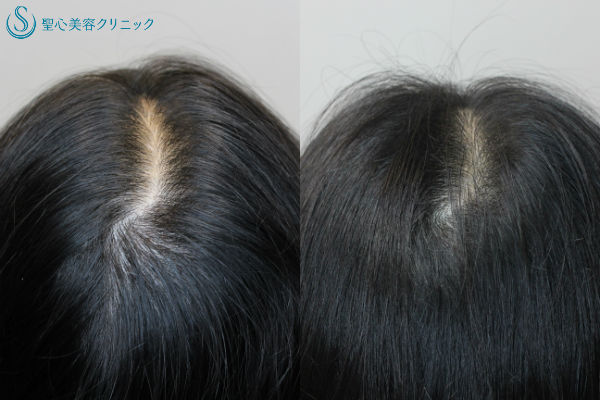 【40代女性・薄毛】グロースファクター再生療法、KIPスカルプへエッセンス、パントガール After 