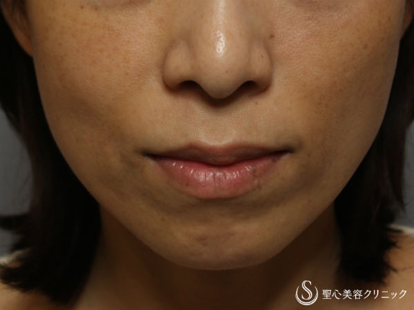 【40代女性】頬のヒアルロン酸注入 Before 
