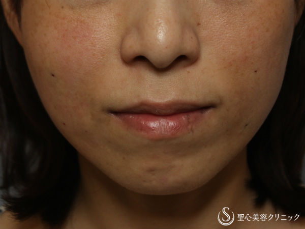 【40代女性】頬のヒアルロン酸注入 After 