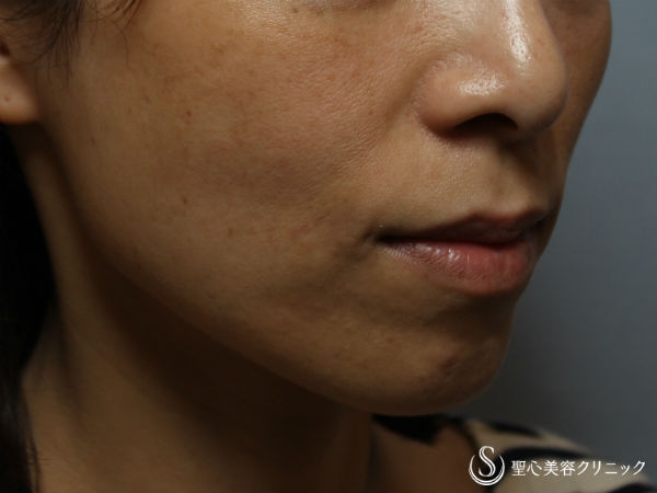 【40代女性】頬のヒアルロン酸注入 Before 