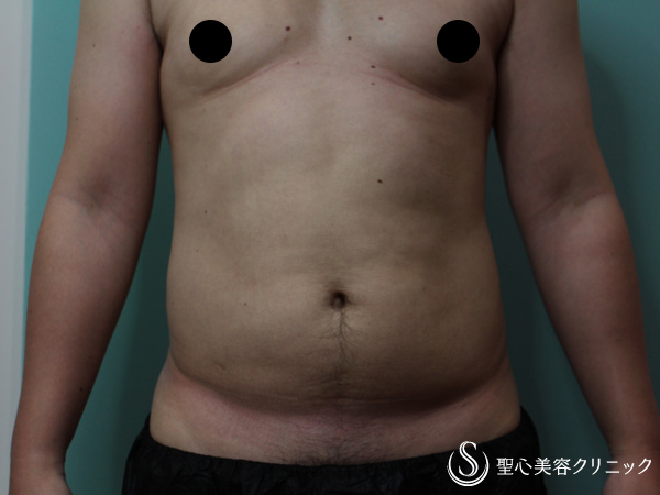 【30代男性・脂肪吸引（お腹周り）】ベイザーリポ2.2（2ヶ月後） Before 