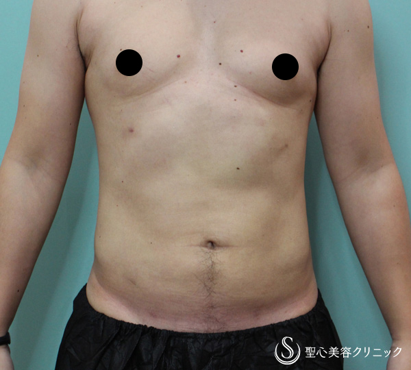 【30代男性・脂肪吸引（お腹周り）】ベイザーリポ2.2（2ヶ月後） After 