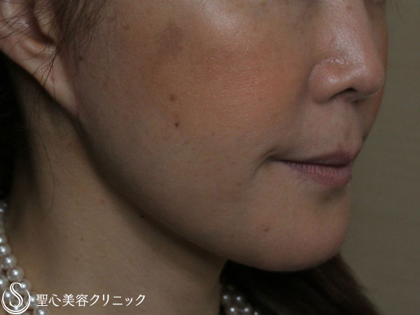 【40代女性・口元のたるみ】プレミアムミニリフト After 